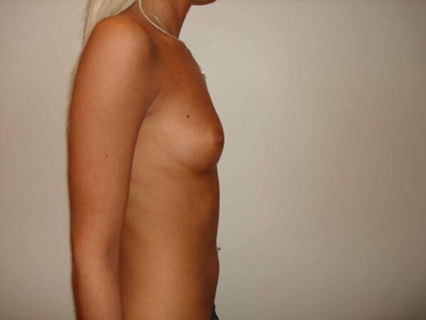 Breast Augmentation Before & After