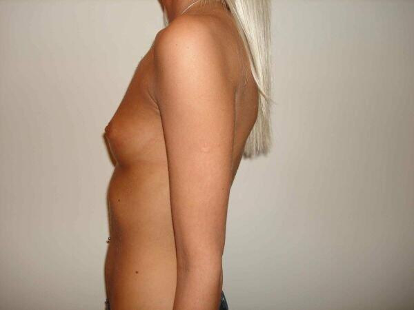 Breast Augmentation Before & After