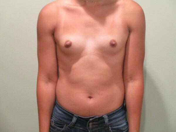 Breast Augmentation Before & After