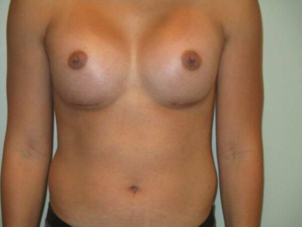 Breast Augmentation Before & After