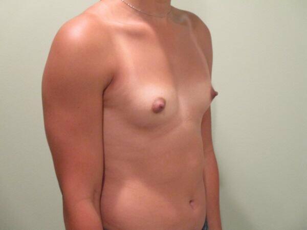 Breast Augmentation Before & After