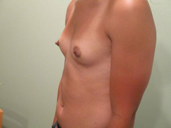 Breast Augmentation Before & After