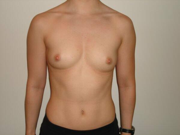 Breast Augmentation Before & After