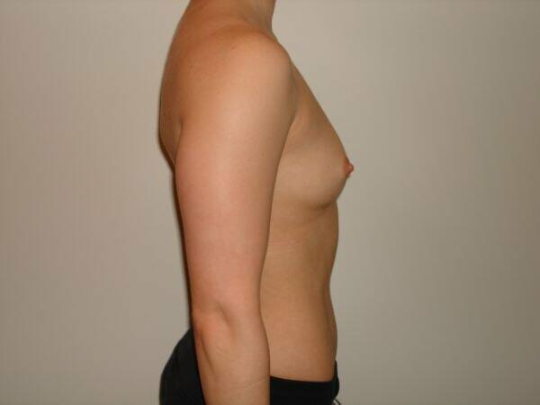 Breast Augmentation Before & After