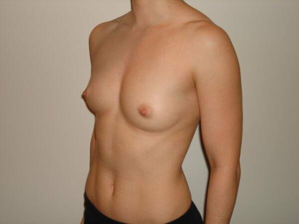 Breast Augmentation Before & After