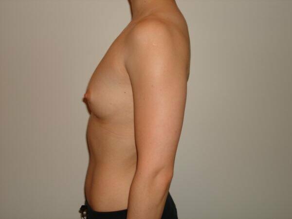 Breast Augmentation Before & After