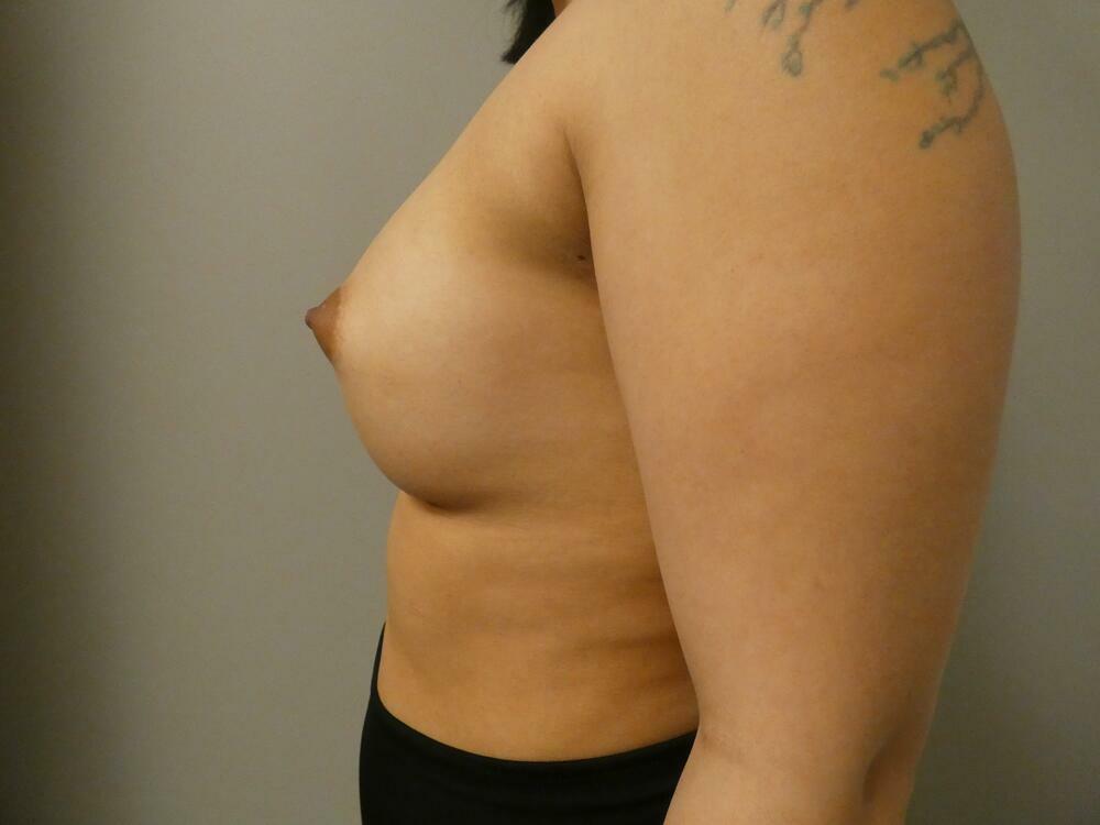 Breast Augmentation Before & After