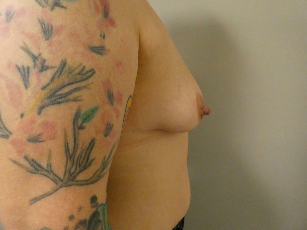 Breast Augmentation Before & After