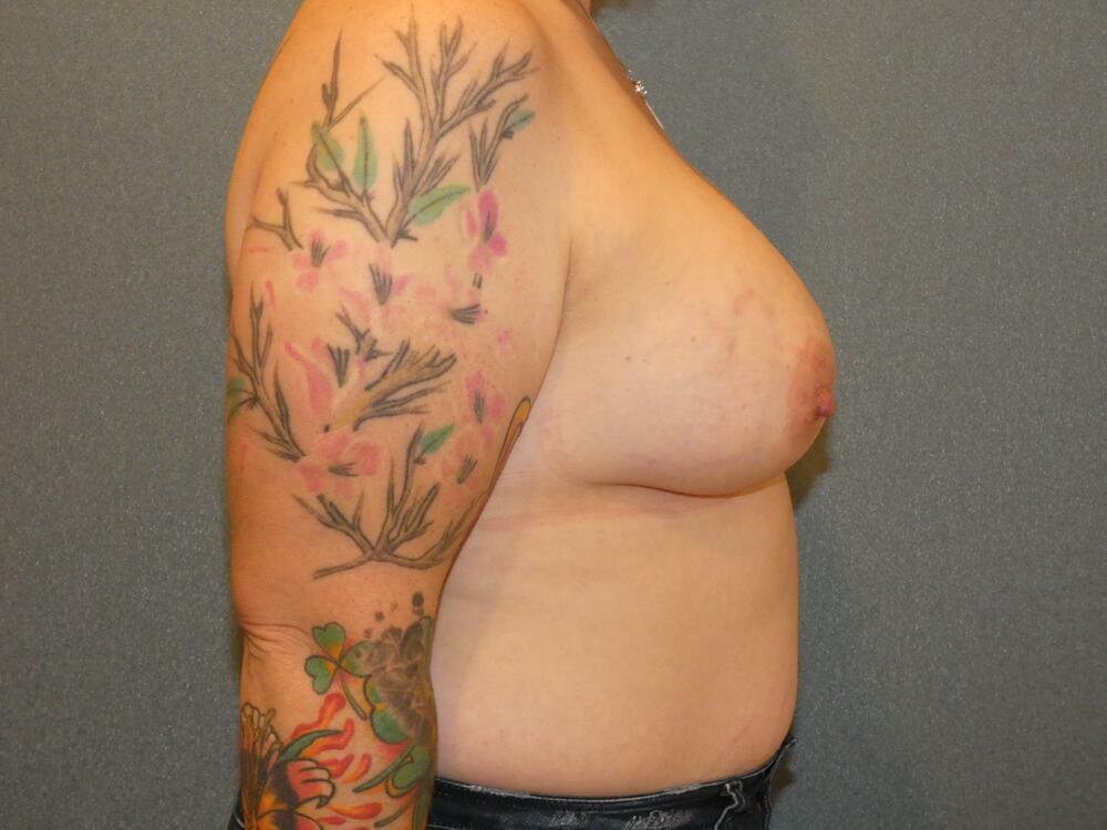 Breast Augmentation Before & After