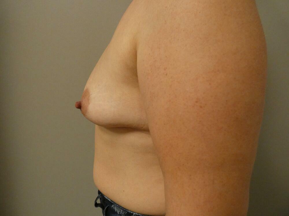 Breast Augmentation Before & After