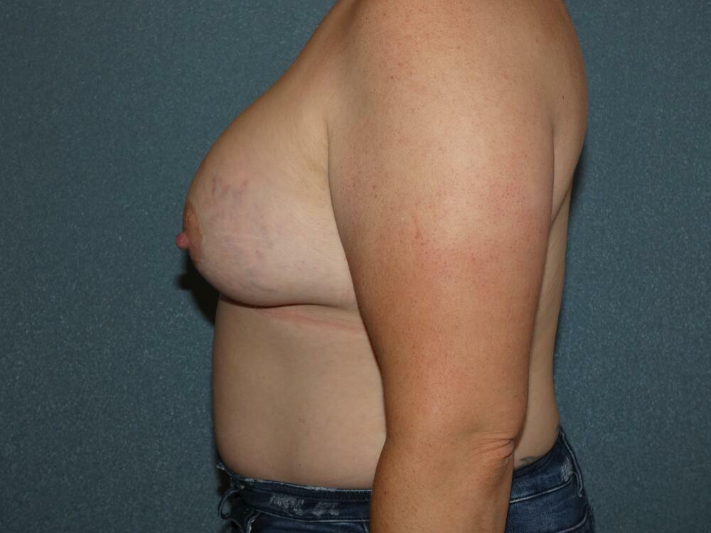 Breast Augmentation Before & After