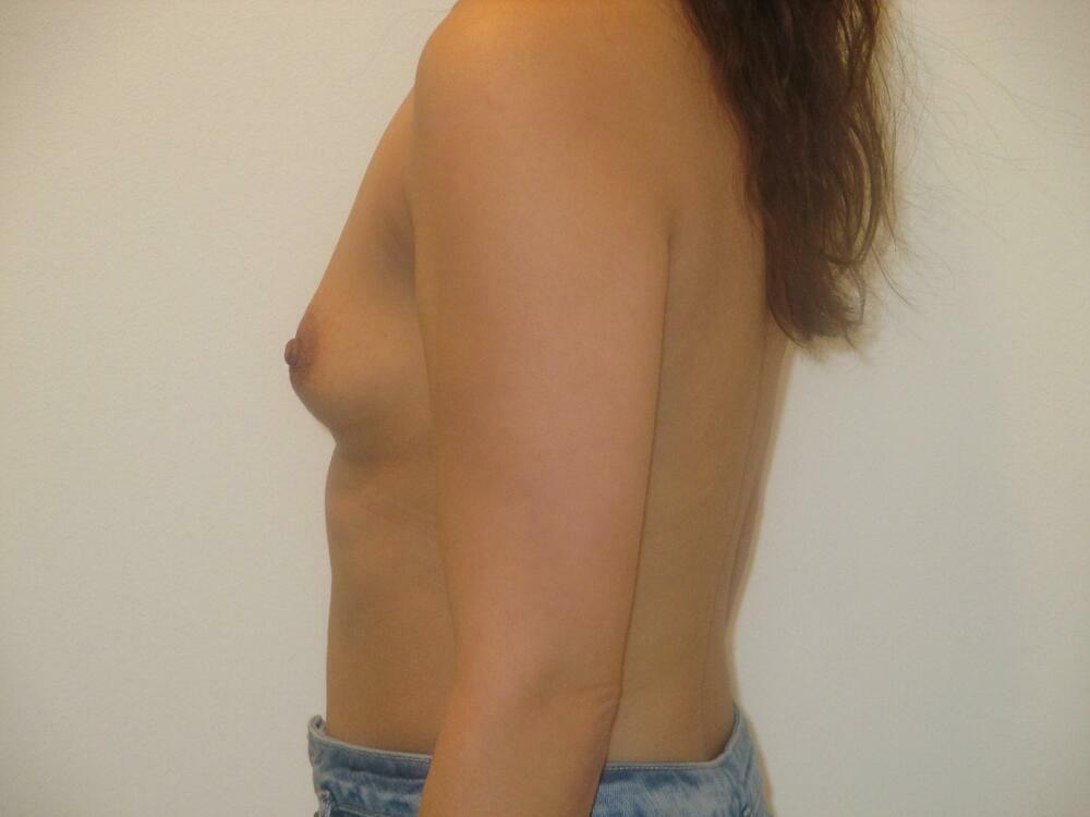 Breast Augmentation Before & After