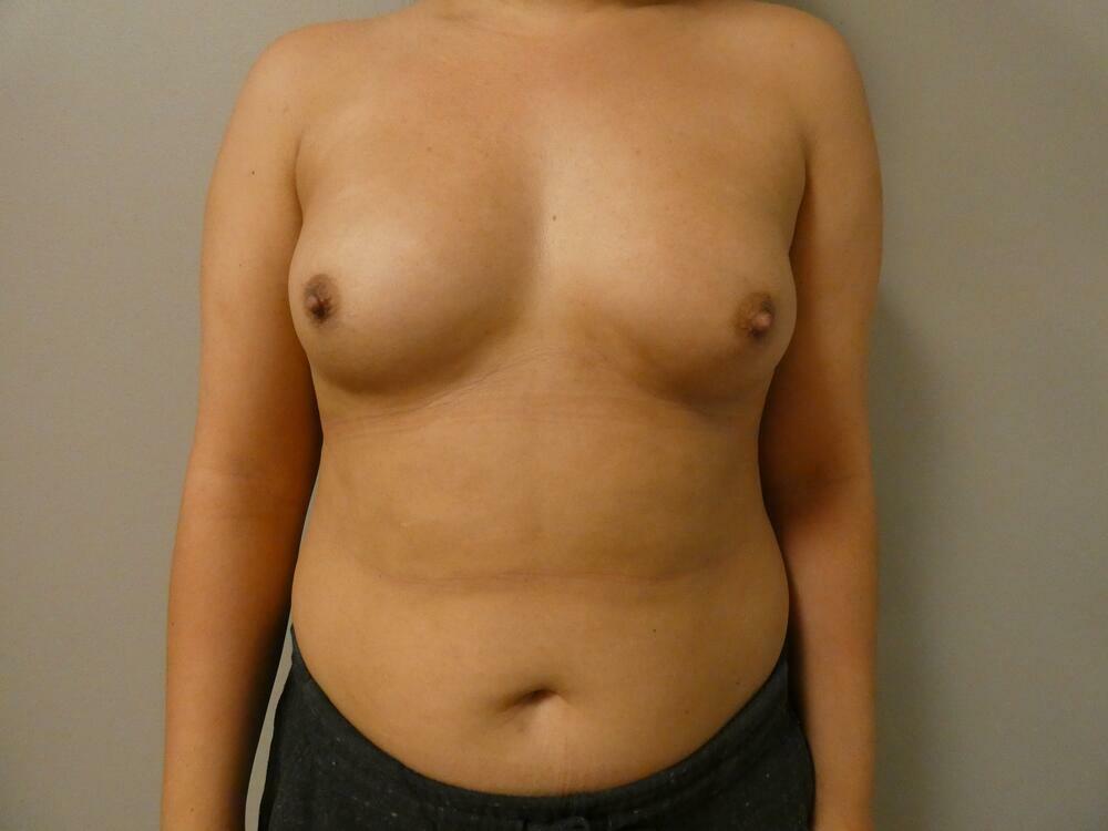 Breast Augmentation Before & After