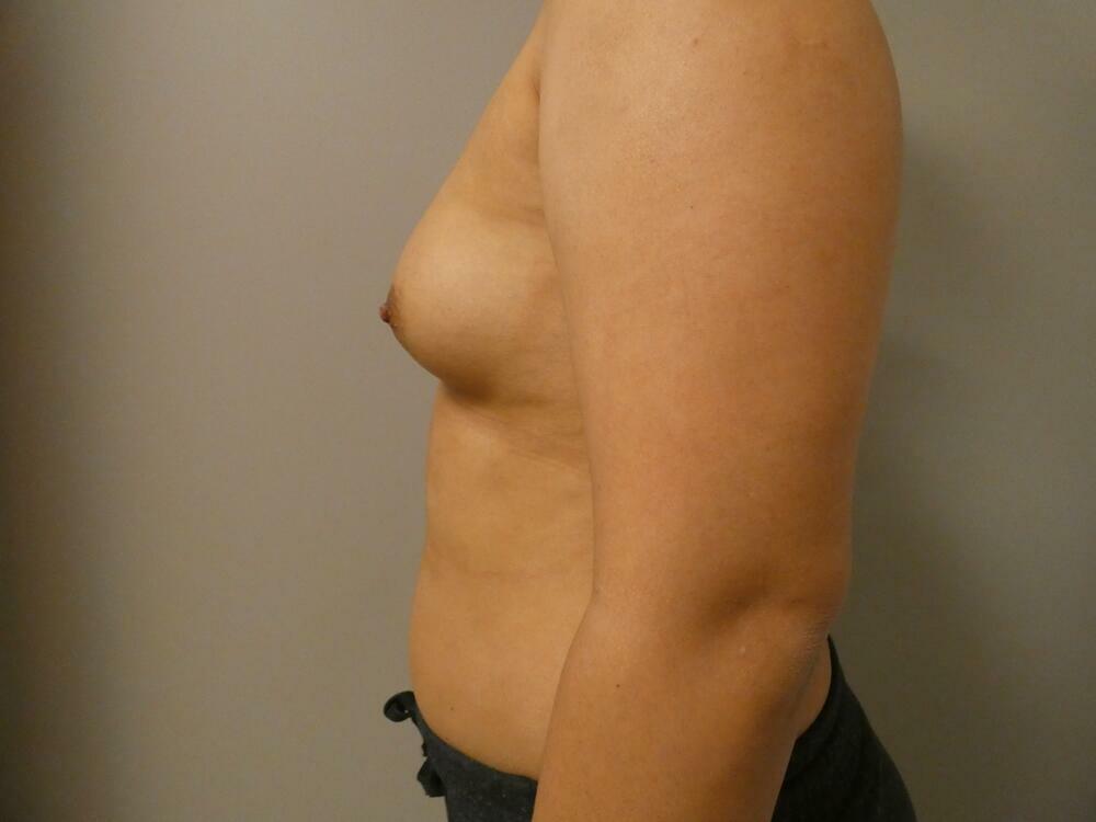 Breast Augmentation Before & After