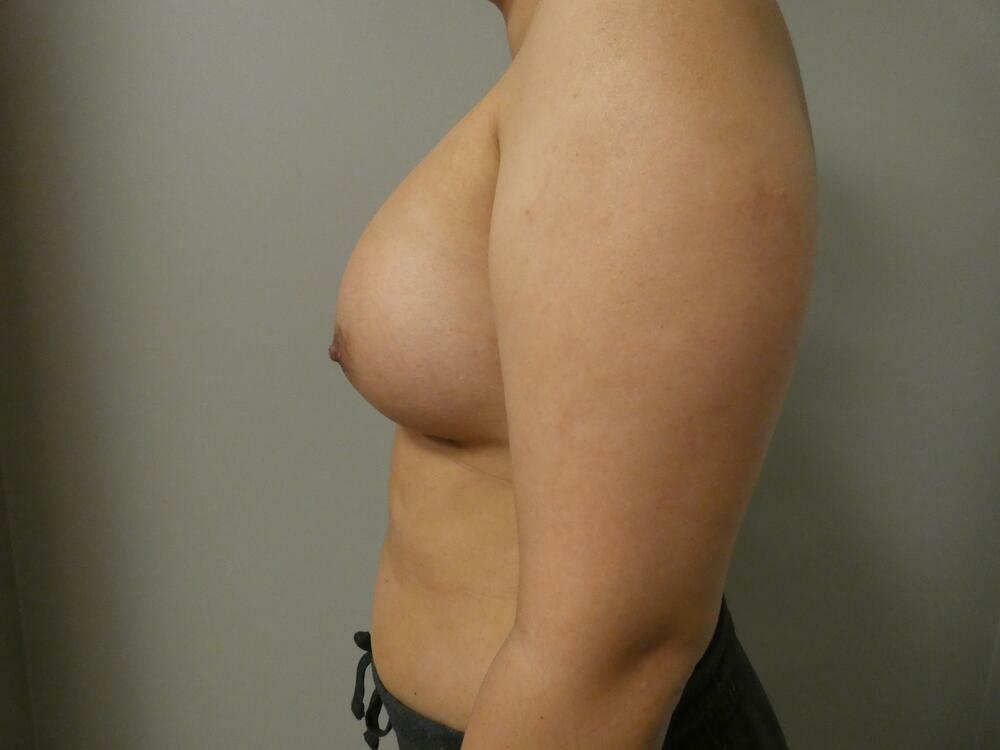 Breast Augmentation Before & After