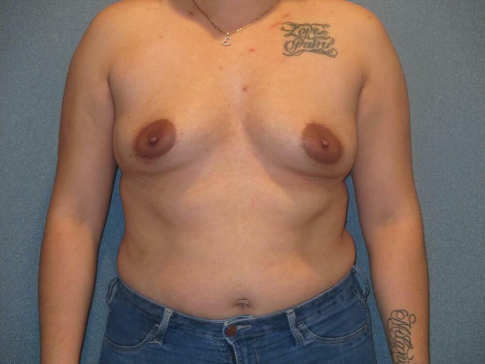 Breast Augmentation Before & After