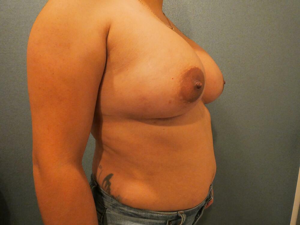 Breast Augmentation Before & After