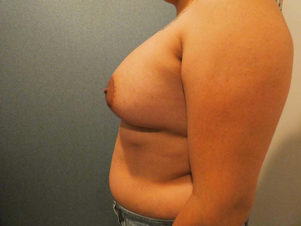 Breast Augmentation Before & After