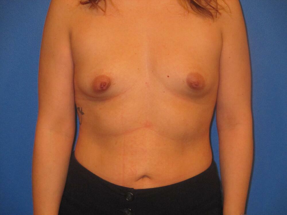 Breast Augmentation Before & After