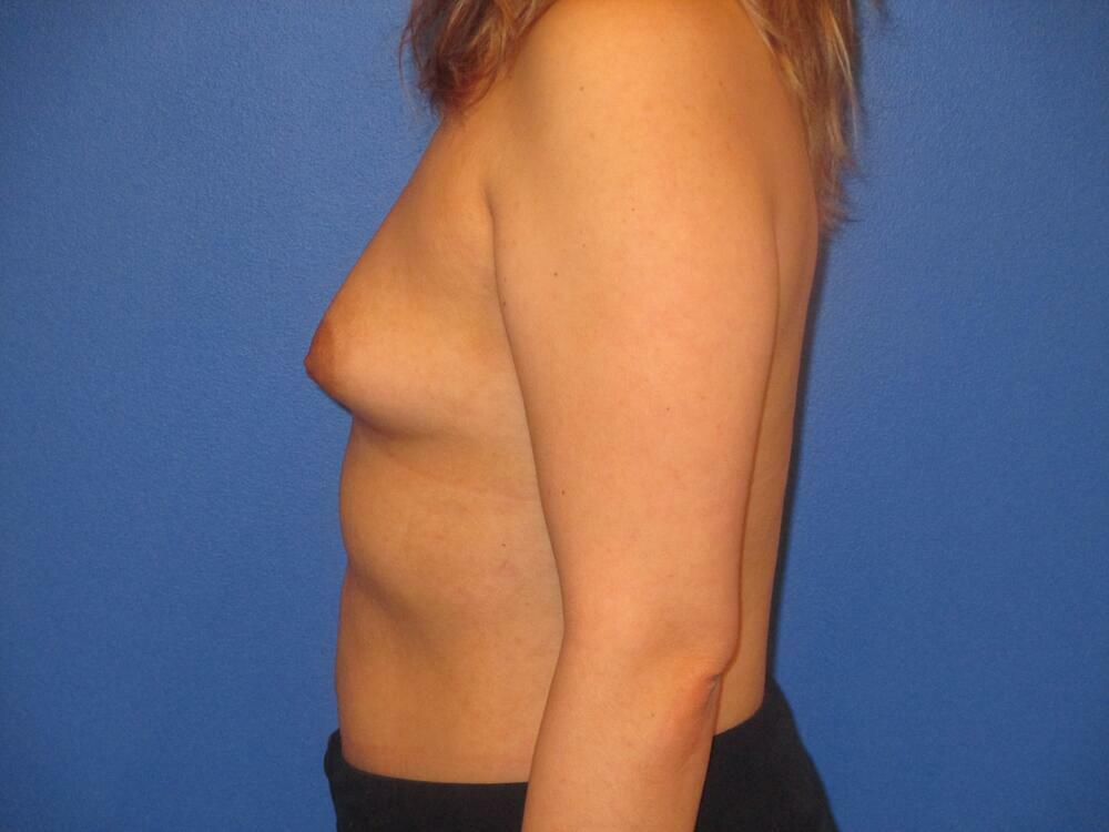 Breast Augmentation Before & After