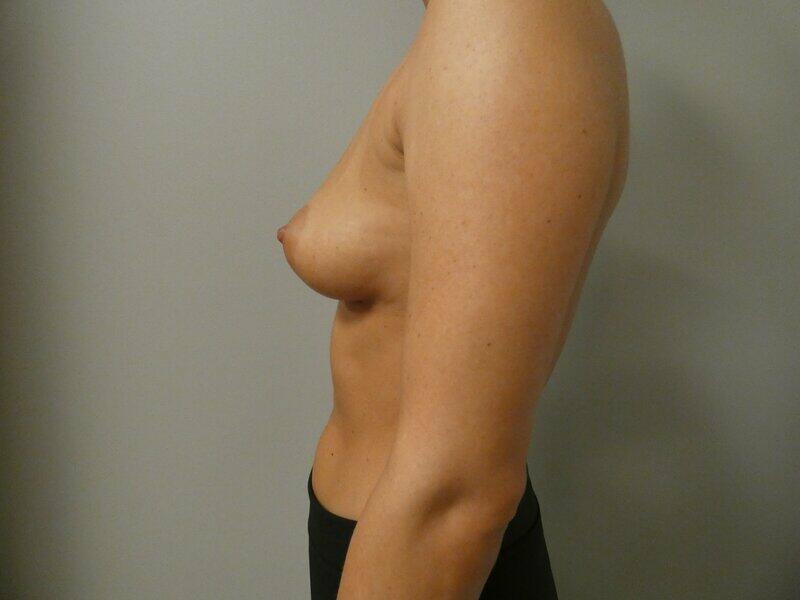 Breast Augmentation Before & After