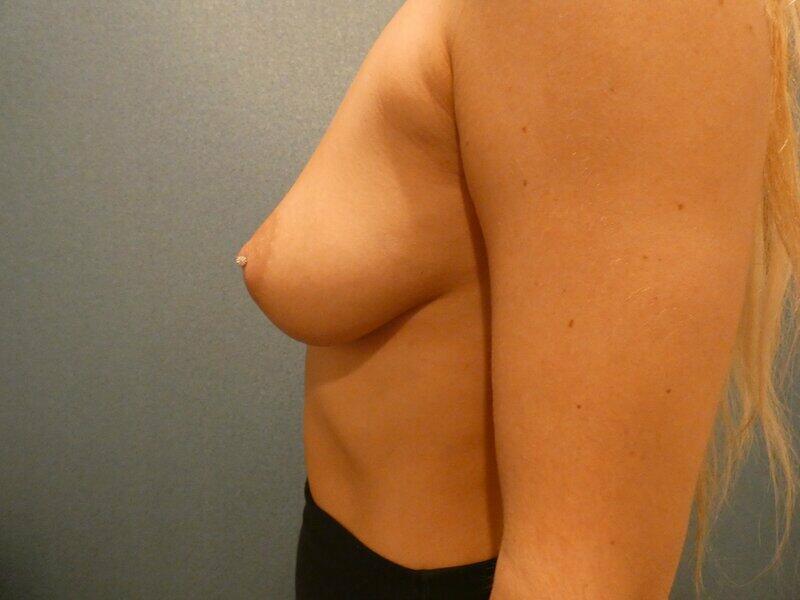 Breast Augmentation Before & After