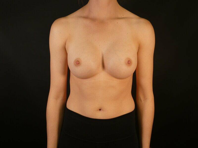 Breast Augmentation Before & After