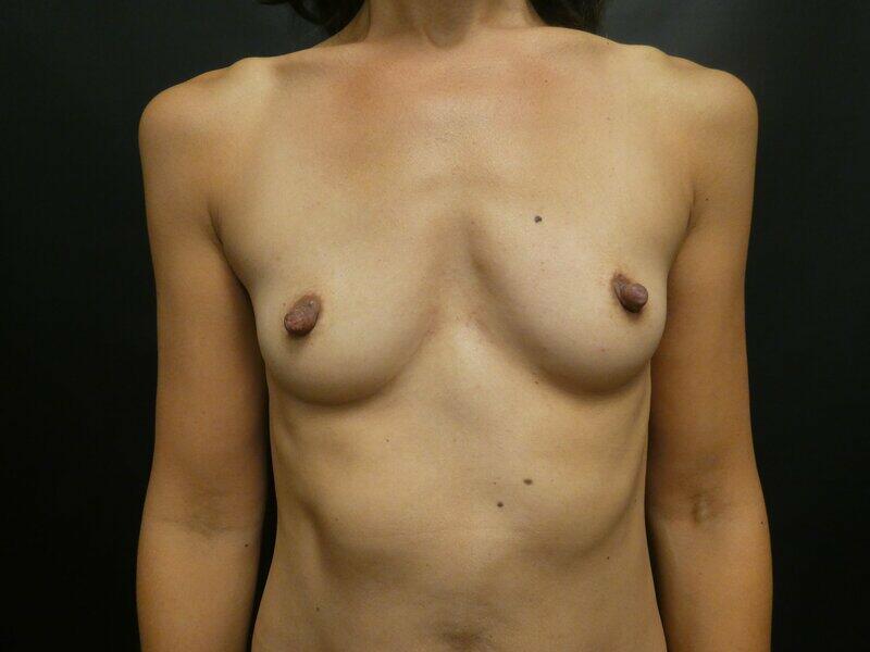 Breast Augmentation Before & After