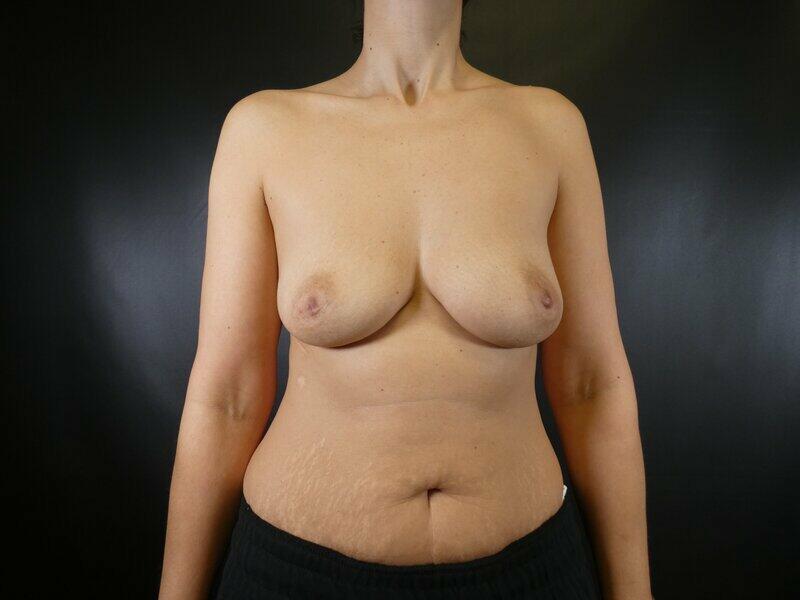 Breast Augmentation Before & After