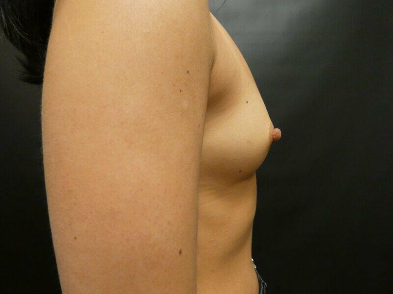 Breast Augmentation Before & After