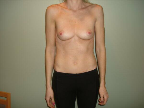 Breast Augmentation Before & After