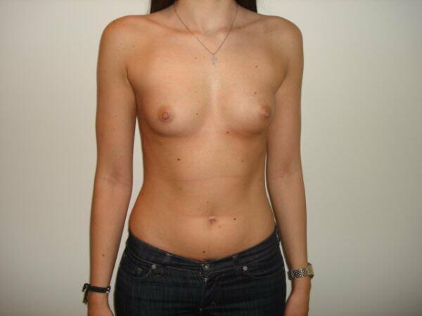 Breast Augmentation Before & After