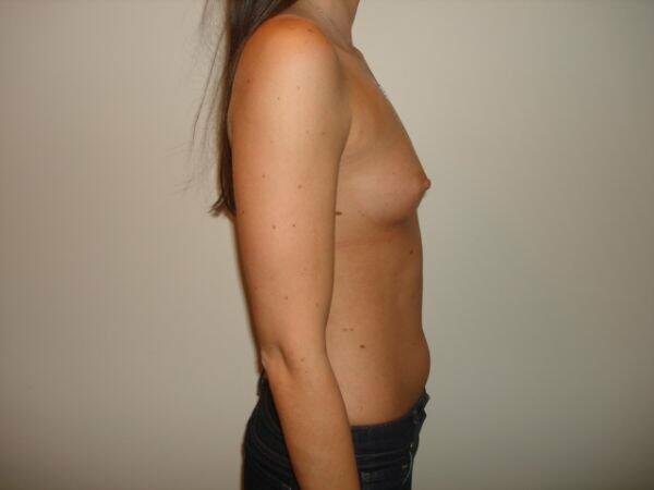 Breast Augmentation Before & After