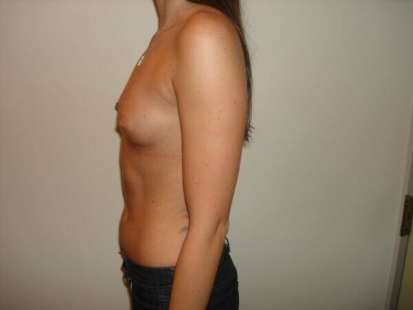 Breast Augmentation Before & After