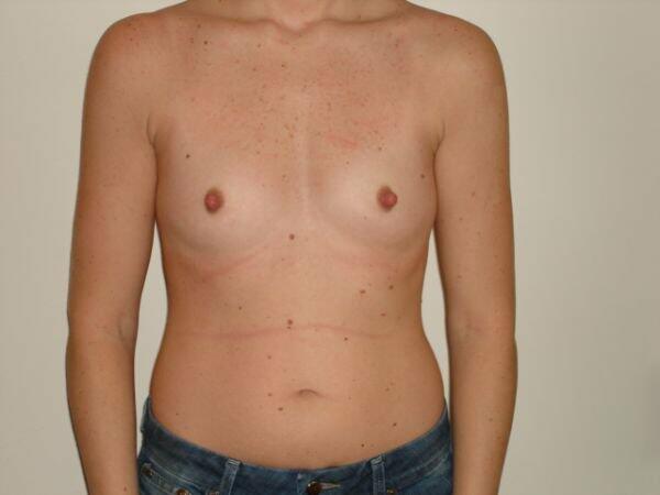 Breast Augmentation Before & After