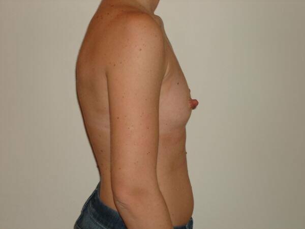 Breast Augmentation Before & After