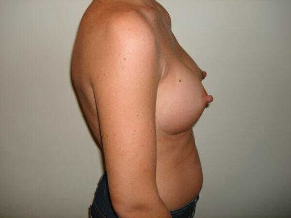 Breast Augmentation Before & After