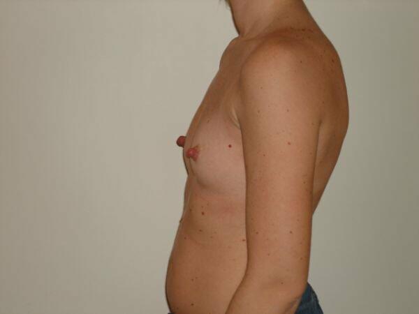 Breast Augmentation Before & After