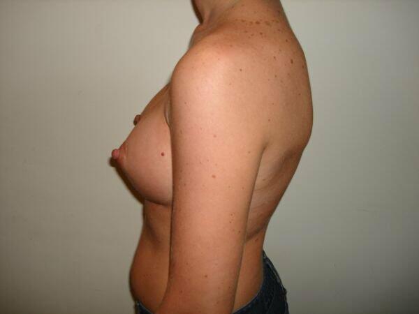 Breast Augmentation Before & After