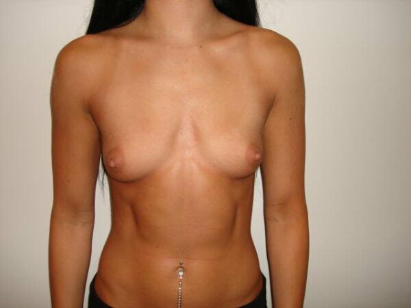 Breast Augmentation Before & After