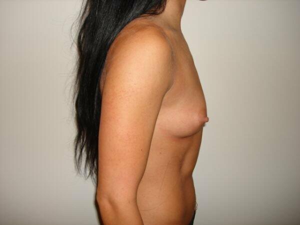 Breast Augmentation Before & After