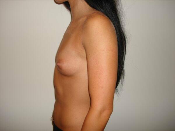 Breast Augmentation Before & After