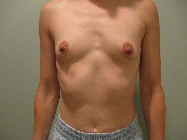 Breast Augmentation Before & After