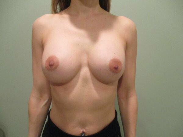 Breast Augmentation Before & After