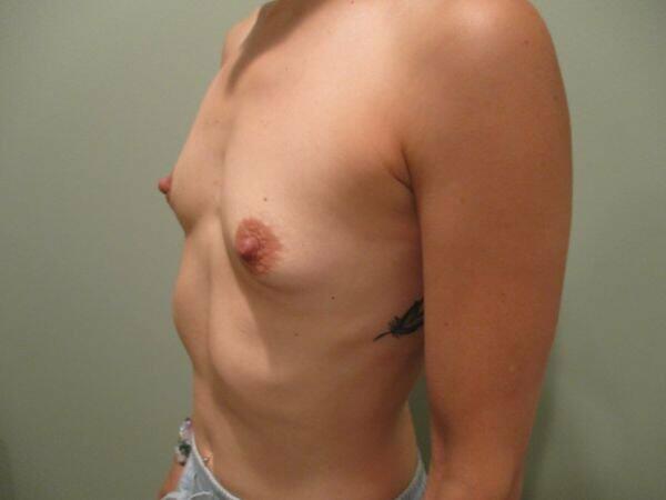 Breast Augmentation Before & After