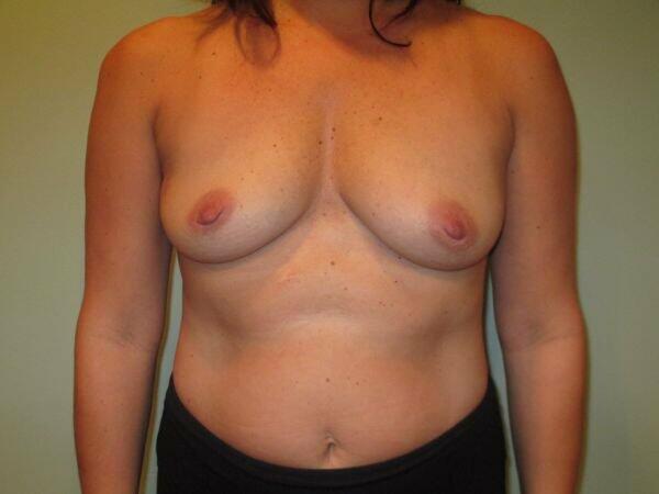 Breast Augmentation Before & After