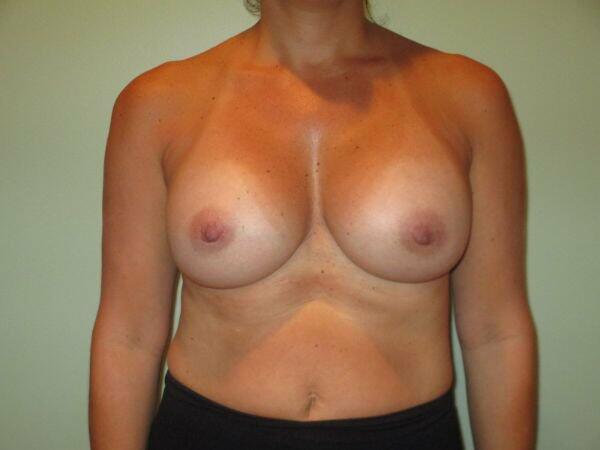 Breast Augmentation Before & After