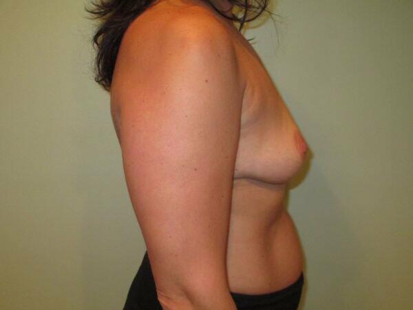 Breast Augmentation Before & After