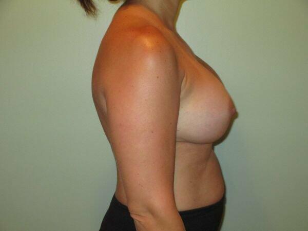 Breast Augmentation Before & After