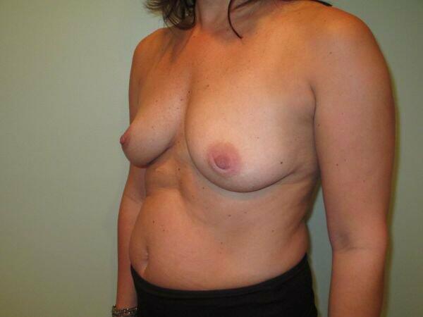 Breast Augmentation Before & After